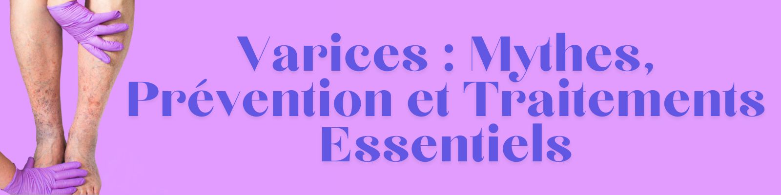 Varices : Mythes, Prévention et Traitements Essentiels